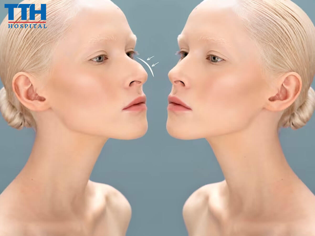 Trường hợp nên sử dụng nâng mũi chỉ Hiko - nâng mũi tại Vinh