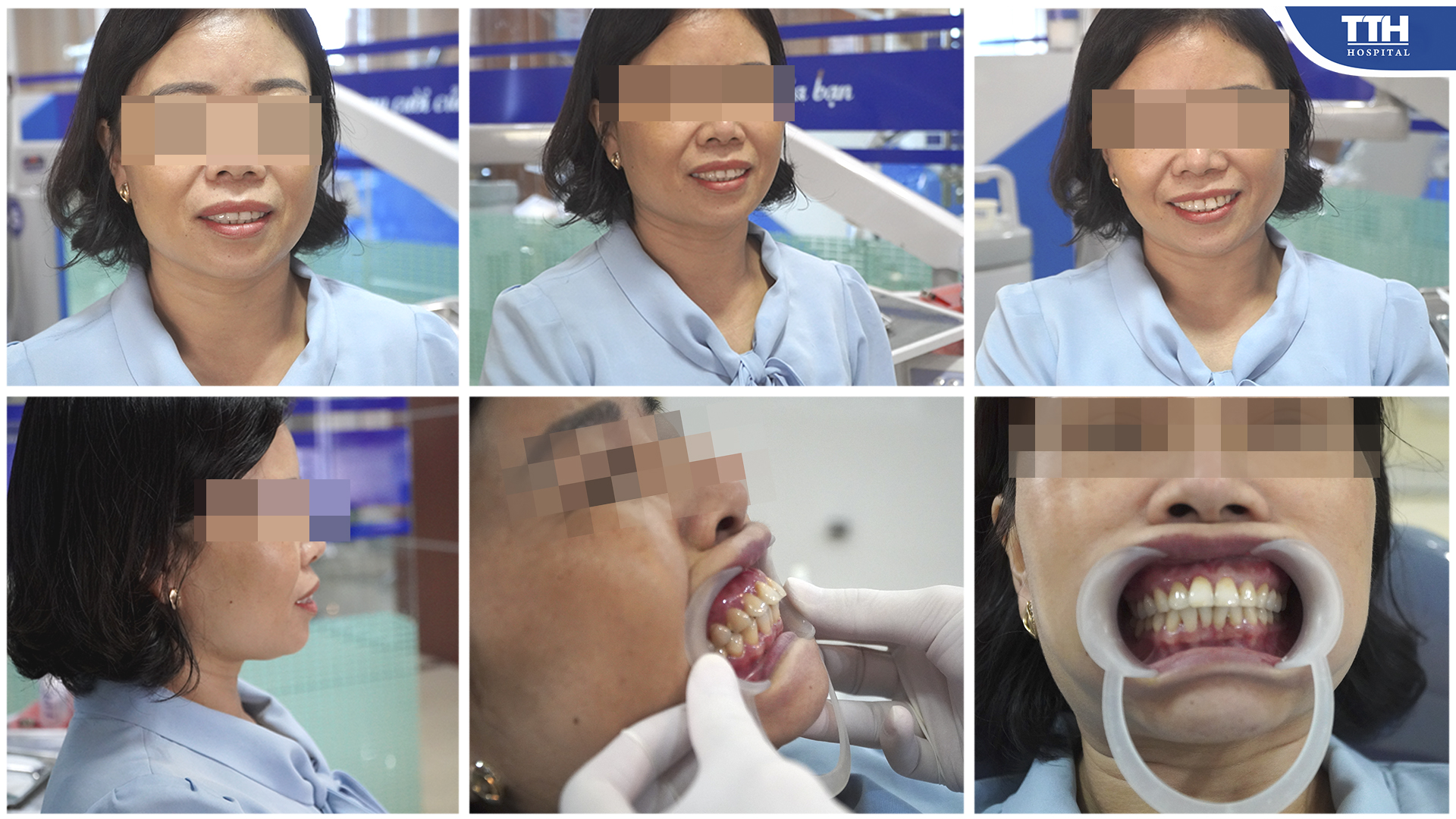 Ghi lại mọi góc độ về nụ cười trước khi thực hiện dịch vụ bằng hình ảnh chất lượng cao 