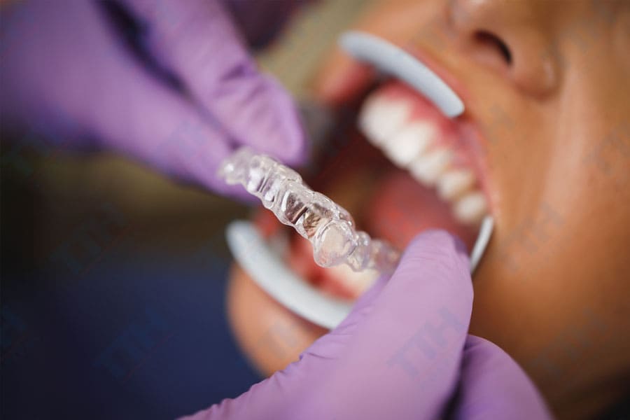 Tuân Thủ Quy Trình Duy Trì Sau Niềng Răng