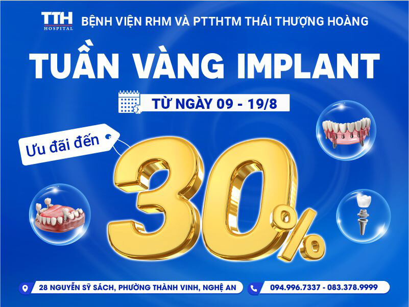 Tuần vàng Implant – Chương trình khuyến mãi với Ưu Đãi Đặc Biệt lên tới 30%