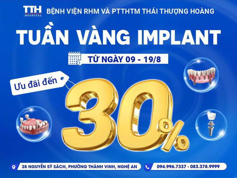 Tuần vàng Implant – Ưu đãi khủng từ 09/08 đến 19/08/2025