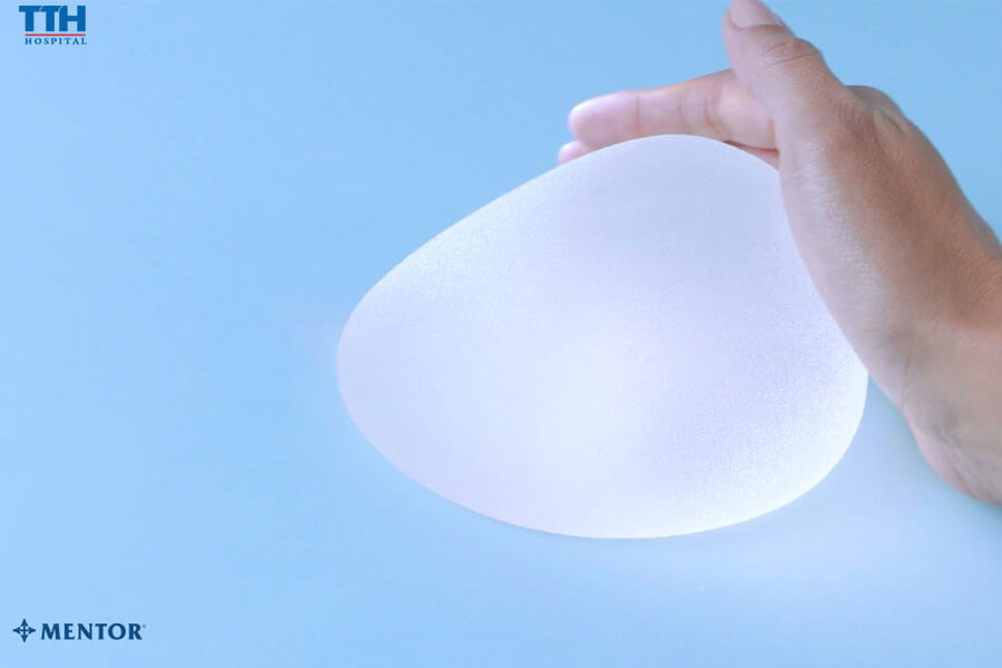 Túi ngực Mentor CPG (Cohesive Patented Gel)