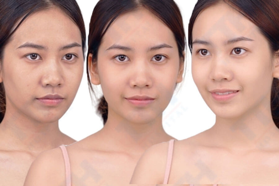 Ứng Dụng Của Oxy Jet Aqua Peel