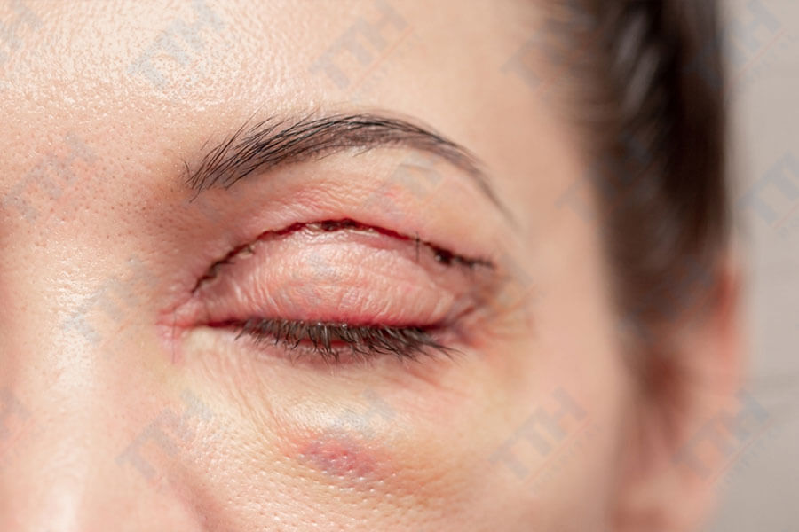 Ứng dụng của Phẫu thuật mí trên Perfect Eyes TTH