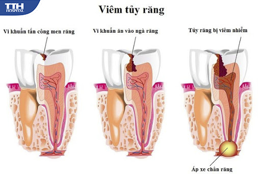 Viêm tủy là gì và dấu hiệu nhận biết?