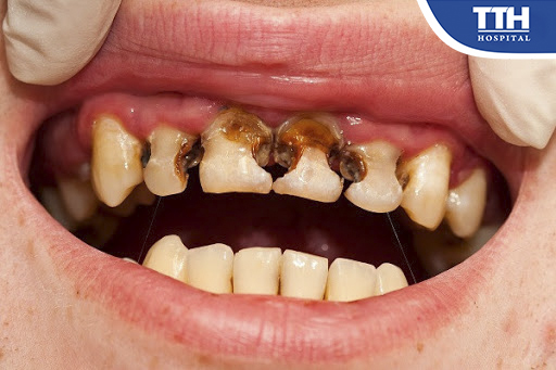 Mất răng sữa do sâu là trường hợp thường gặp, cần đai giữ khoảng để duy trì khoảng trống