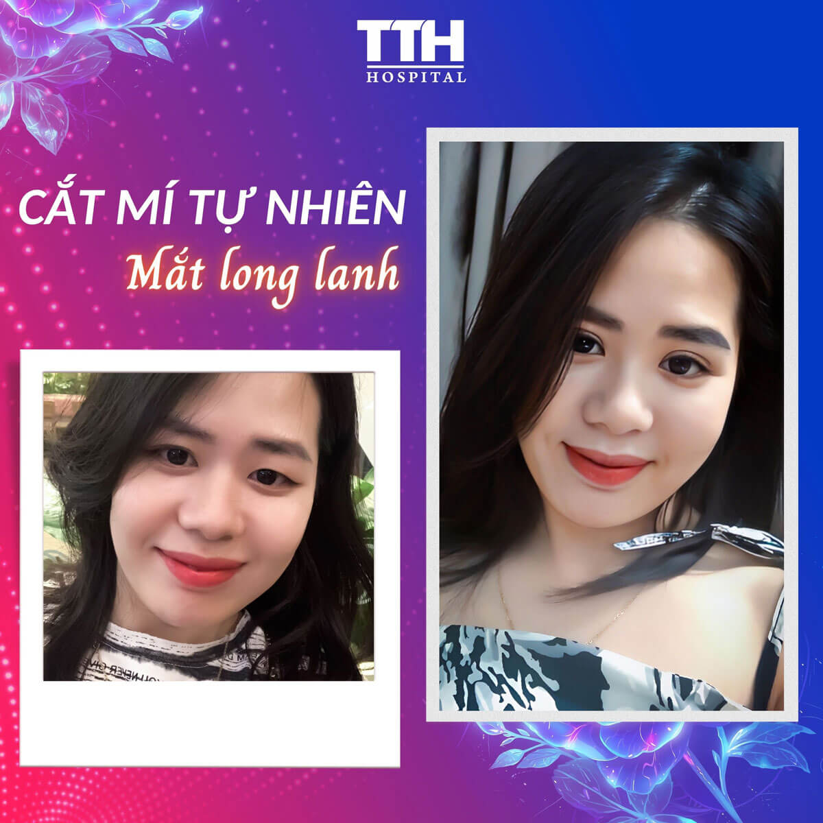 Ưu đãi cắt mí Tuần vàng thẩm mỹ - Quyền năng phái đẹp 15-22/10/2023