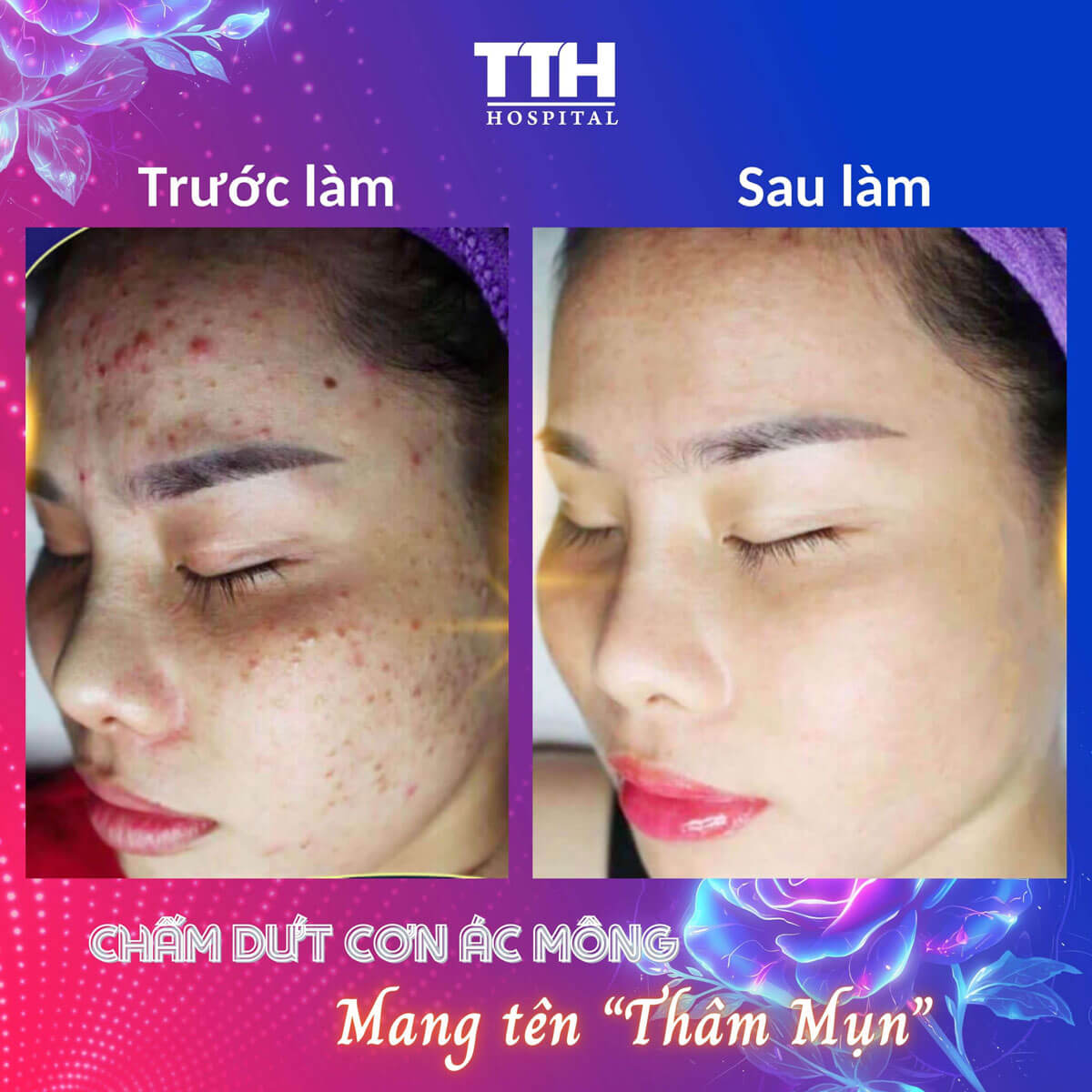 Ưu đãi điều trị mụn Tuần vàng thẩm mỹ - Quyền năng phái đẹp 15-22/10/2023