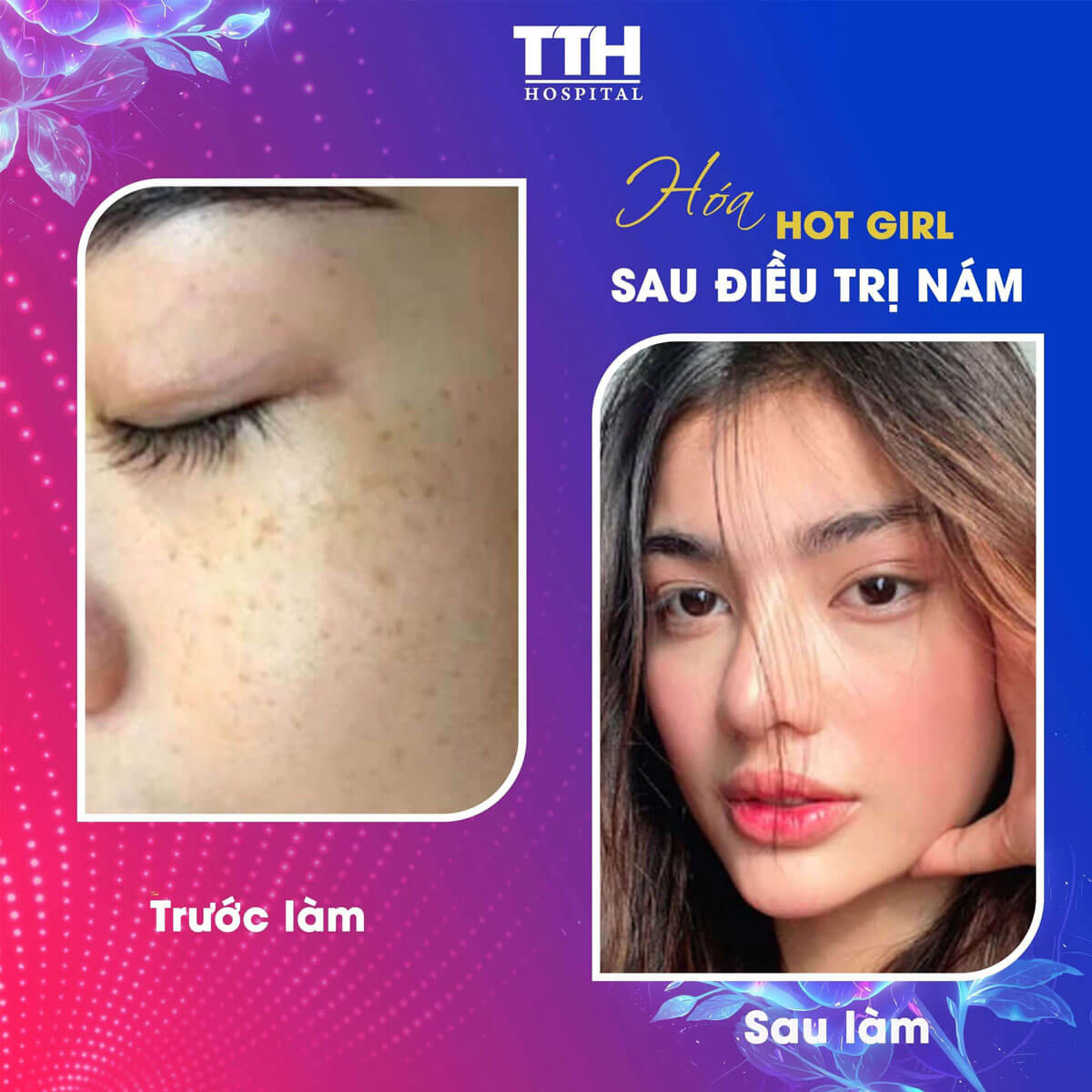 Ưu đãi điều trị nám Tuần vàng thẩm mỹ - Quyền năng phái đẹp 15-22/10/2023