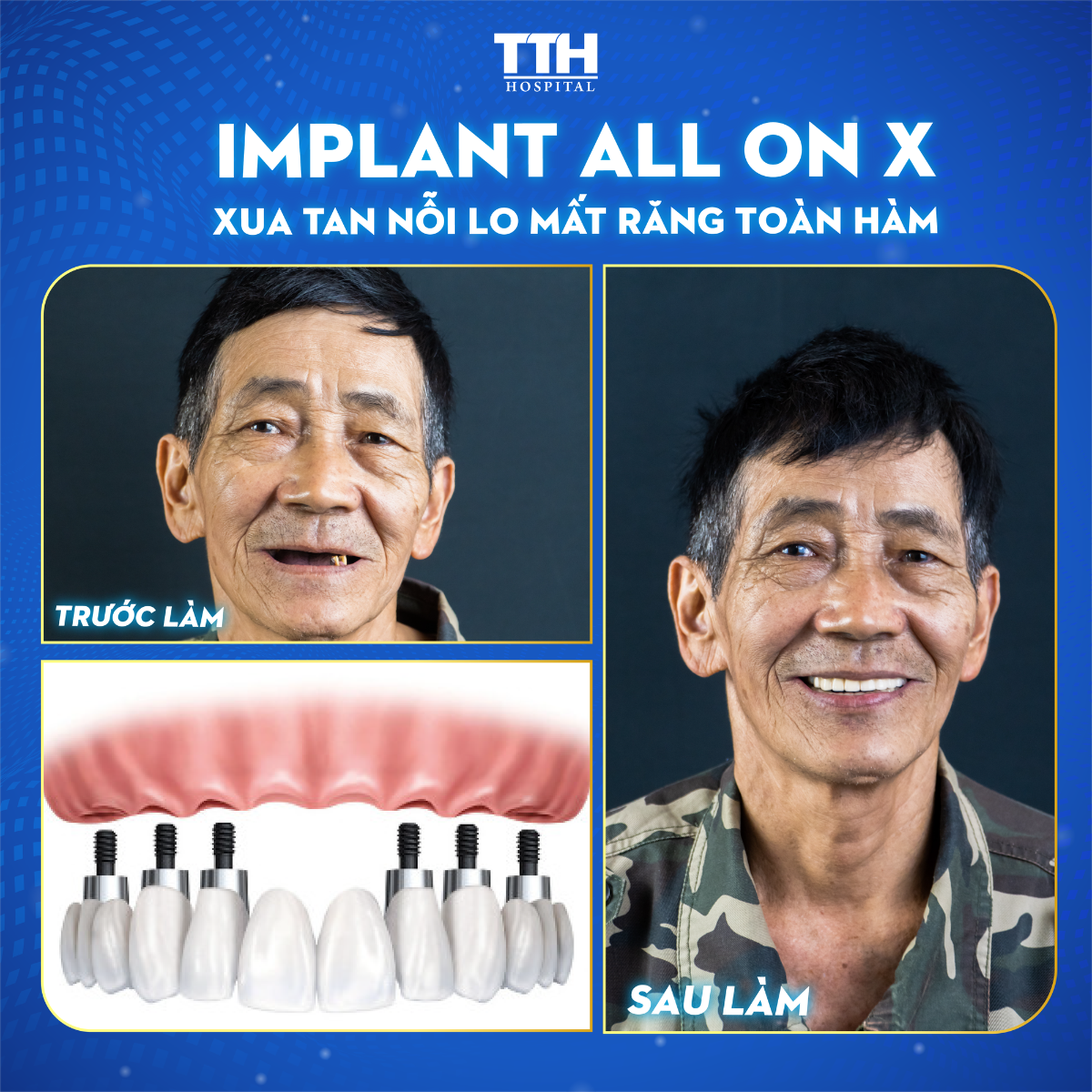 Tuần vàng ưu đãi Iplant