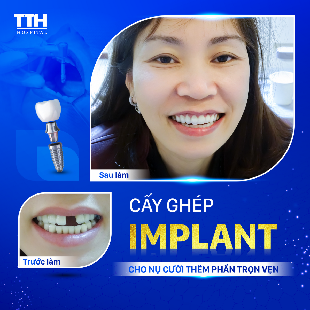 Tuần vàng ưu đãi Implant