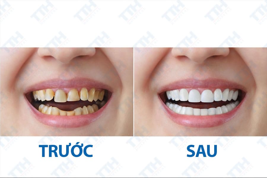 Ưu điểm của Diamond Veneer – vì sao lại được ưa chuộng?