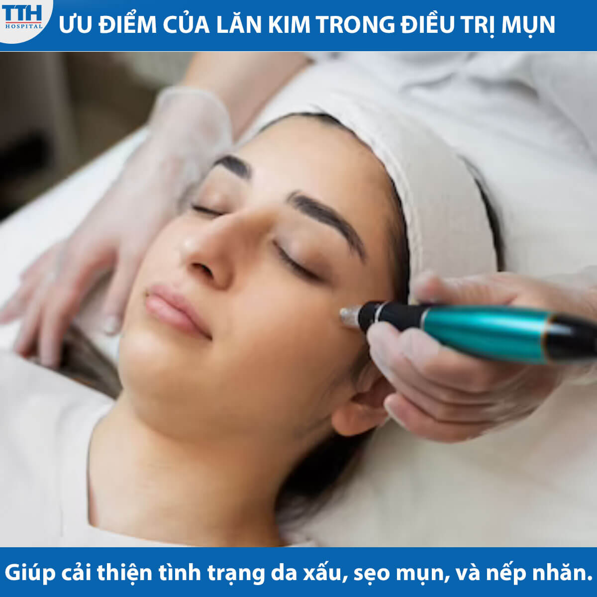 Ưu điểm của lăn kim trong quá trình điều trị mụn