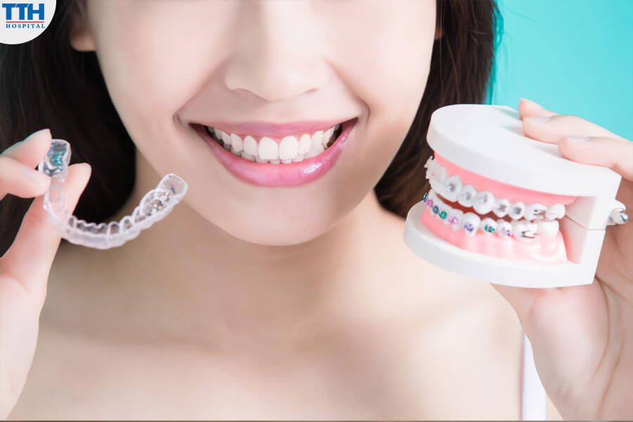 Ưu Điểm Của Niềng Răng Invisalign