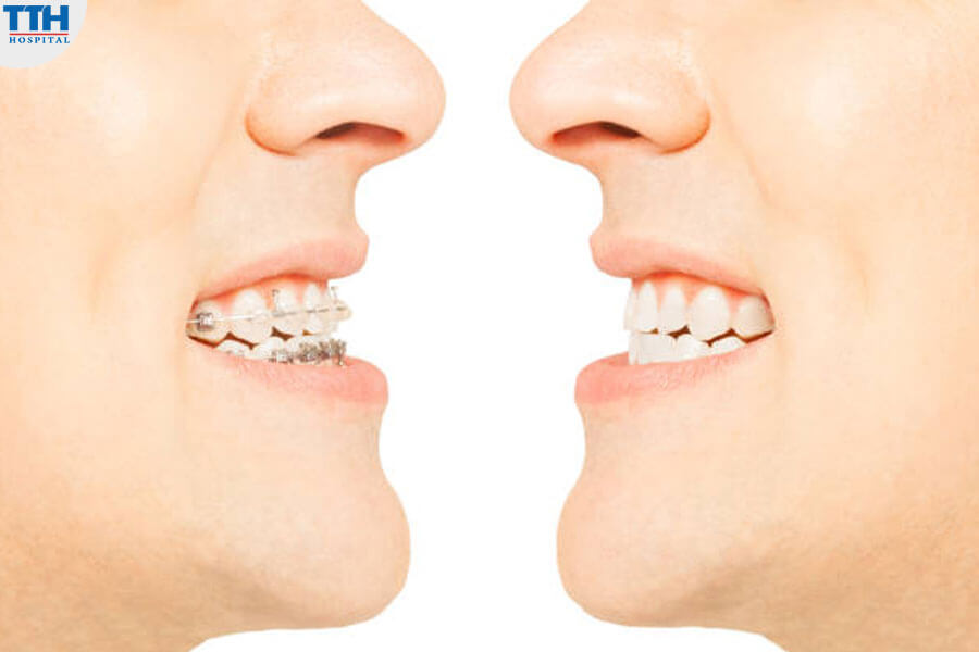 Ưu Điểm Của Niềng Răng Mắc Cài Tự Buộc
