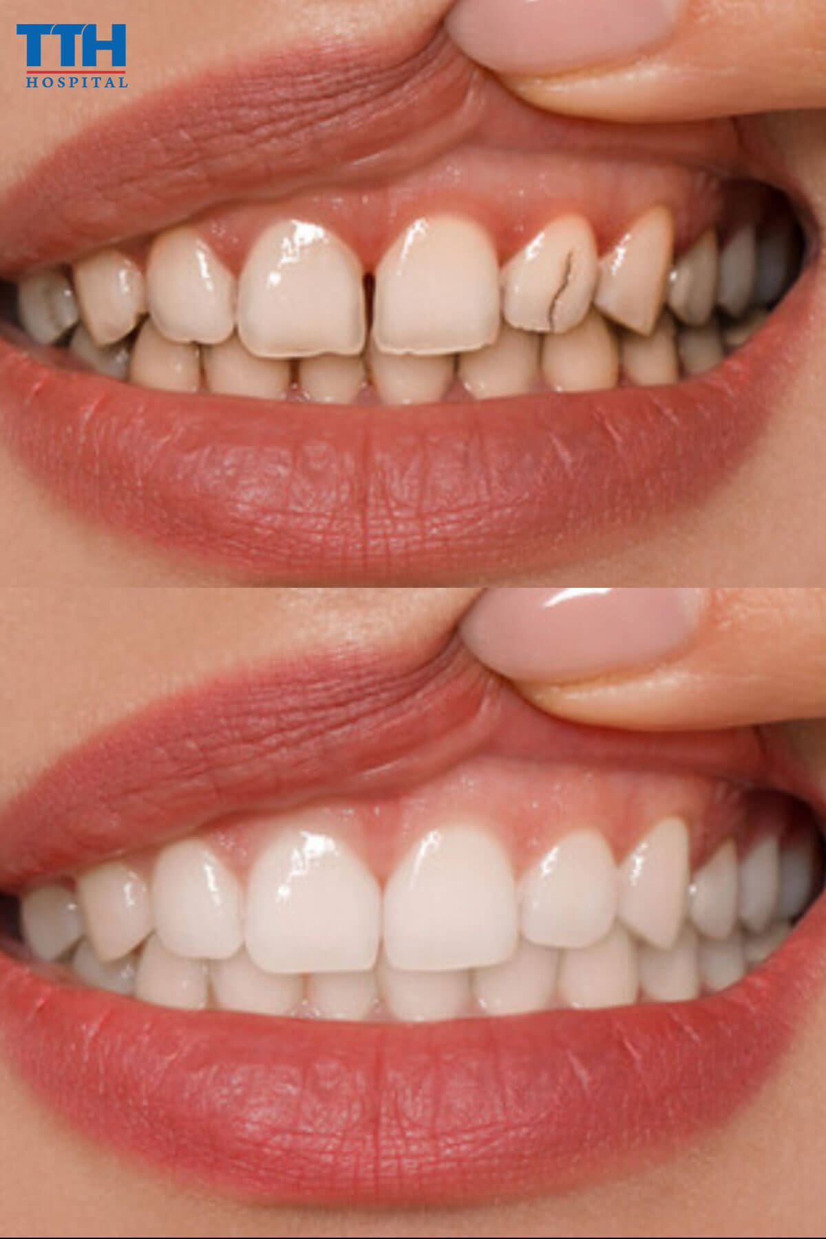 Ưu điểm của răng sứ Diamond Veneer