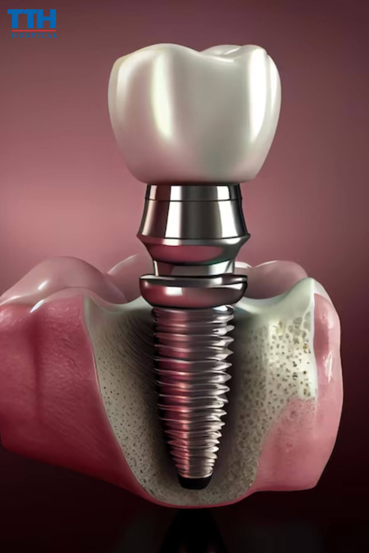 Tầm Quan Trọng Của Việc Phục Hình Răng và Vai Trò Của Implant