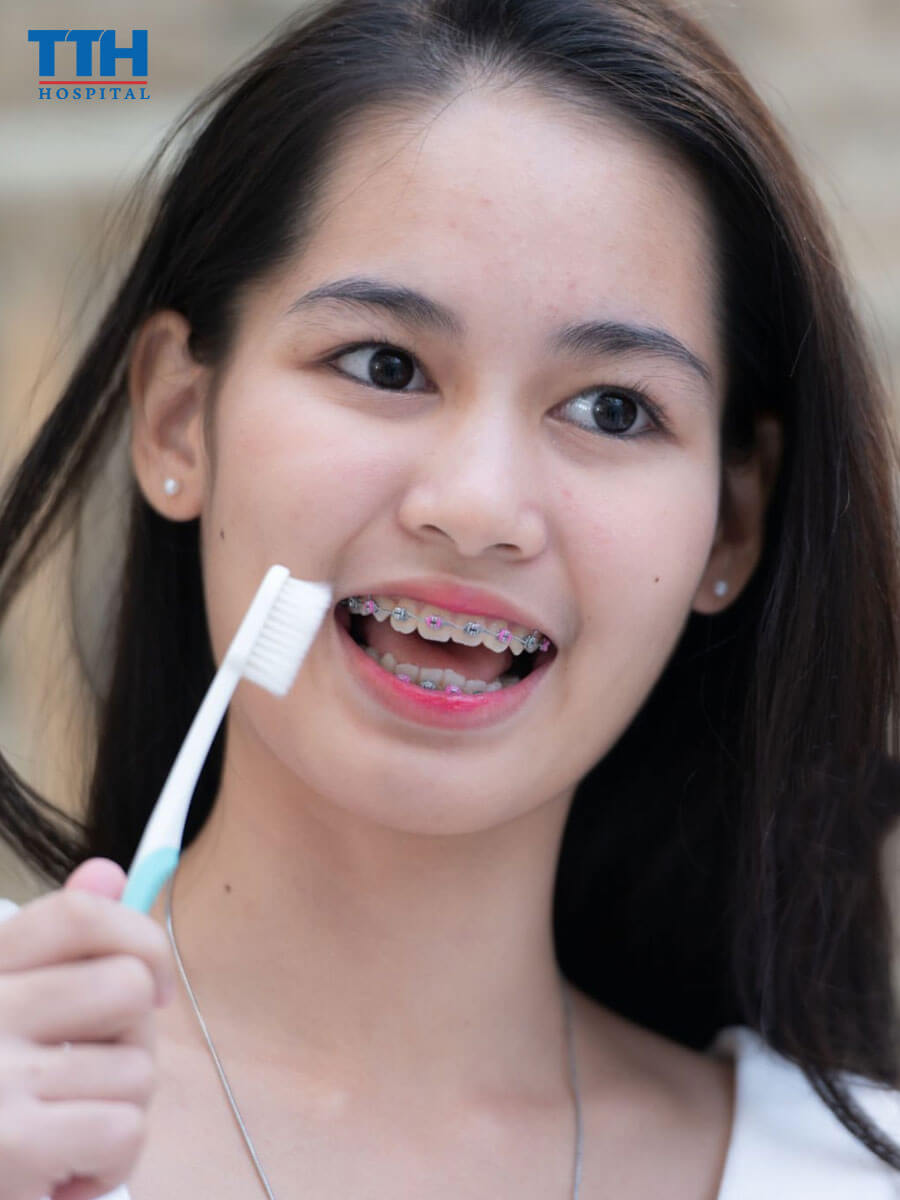 Vệ Sinh Răng Miệng Nhẹ Nhàng khi niềng răng