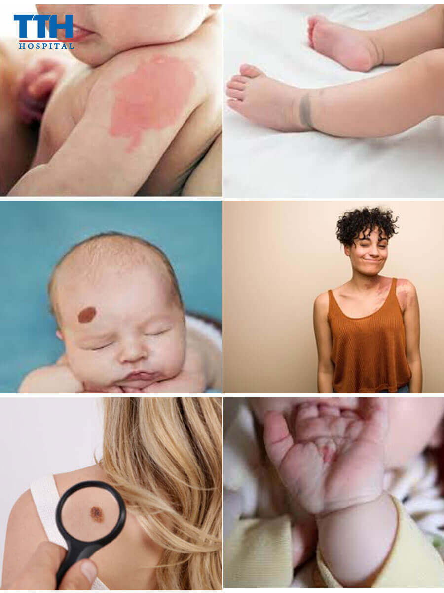 Vết bớt thường xuất hiện ở vị trí nào?