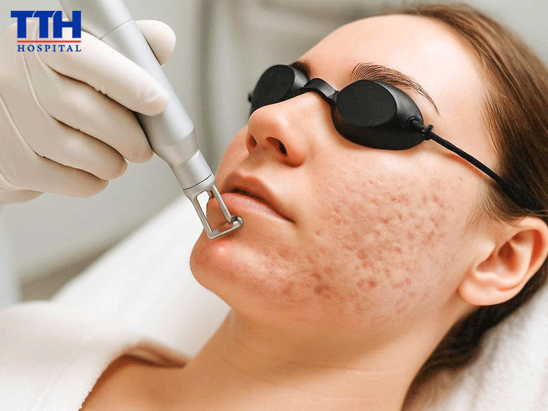Vì sao sẹo rỗ để lâu thường khó cải thiện hơn?
