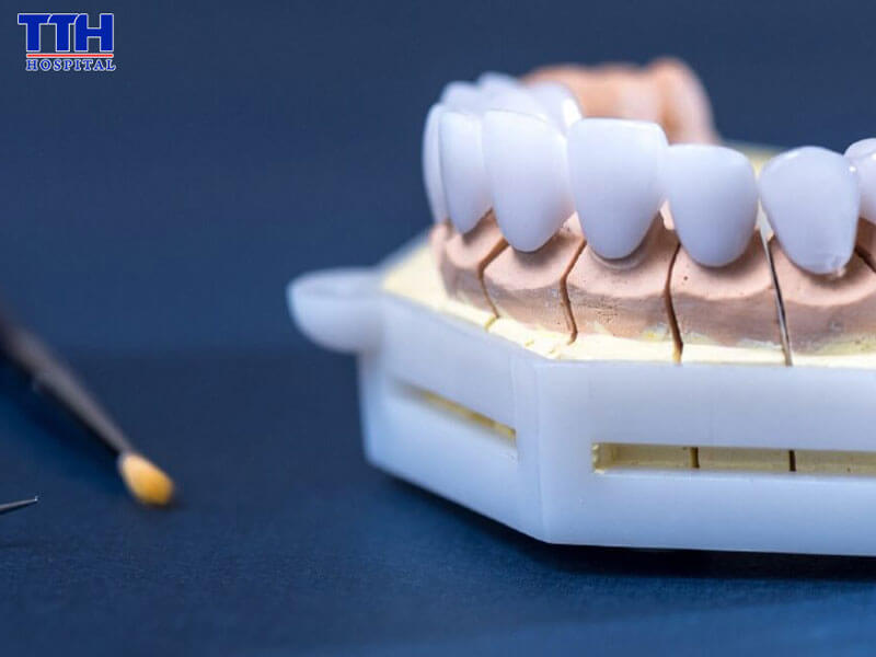 Vì sao Việt kiều lựa chọn bọc răng sứ tại Việt Nam?