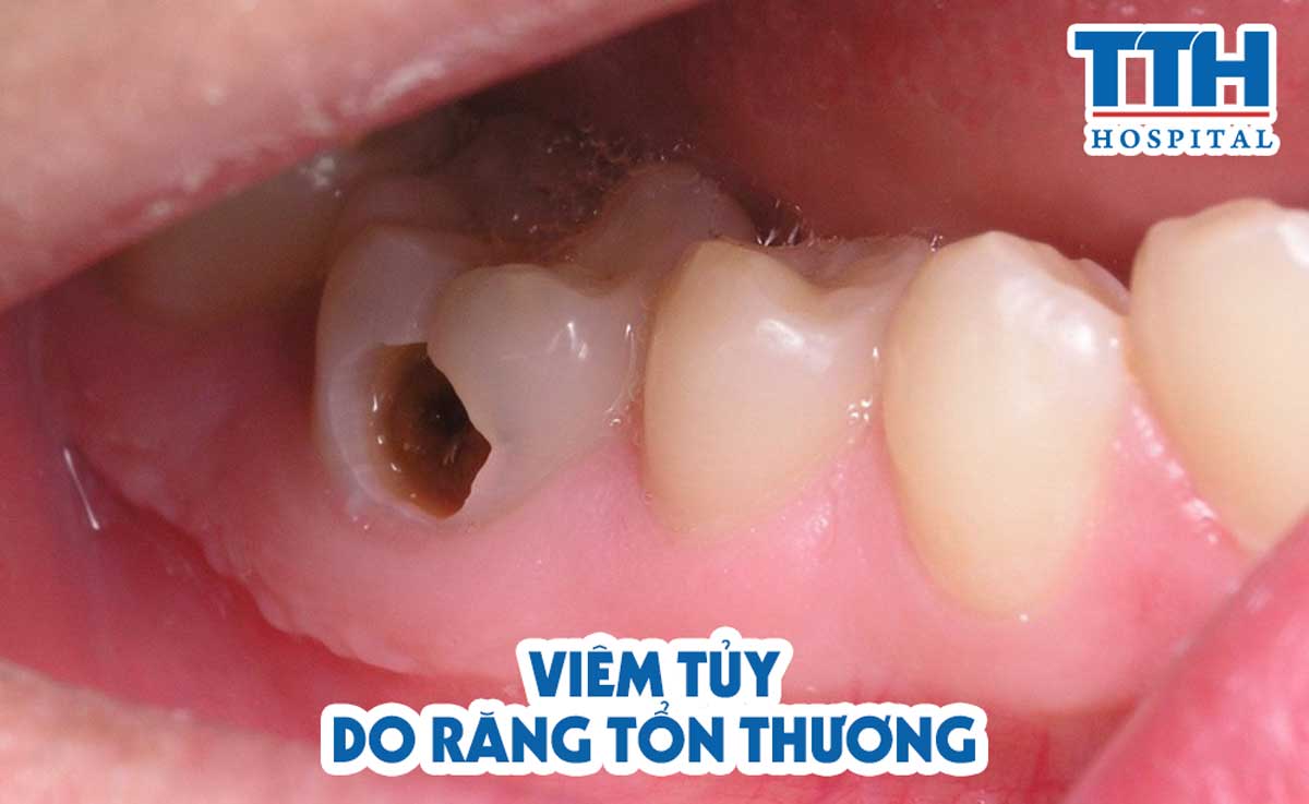 Viêm tủy răng do tổn thương răng