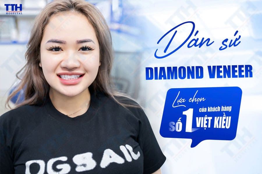 Diamond Veneer – nên hay không nên?