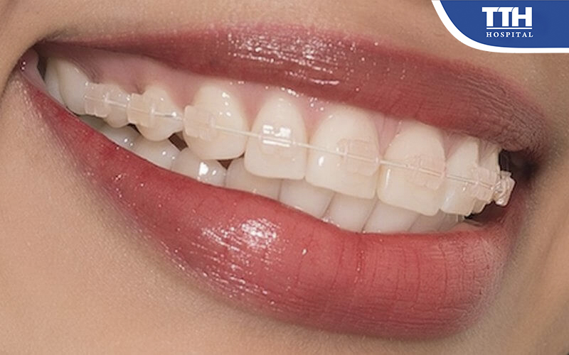 Mắc cài sứ được làm từ hợp kim sứ và các chất vô cơ khác