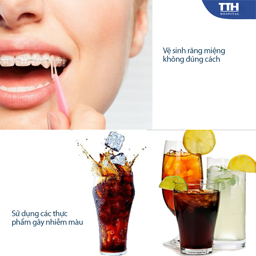 Vệ sinh răng miệng không đúng cách và sử dụng các thực phẩm gây nhiễm màu thường xuyên là nguyên nhân khiến mắc cài sứ bị ố màu