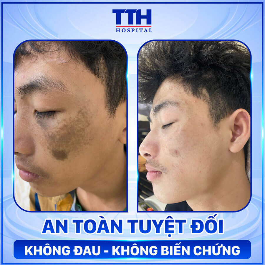 Xóa chàm bớt An toàn tuyệt đối, không đau, không biến chứng