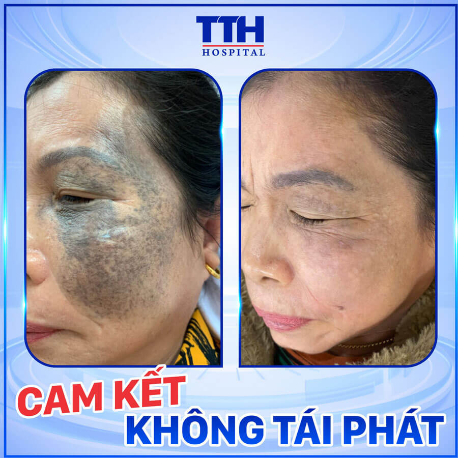Xóa chàm bớt Cam kết không tái phát