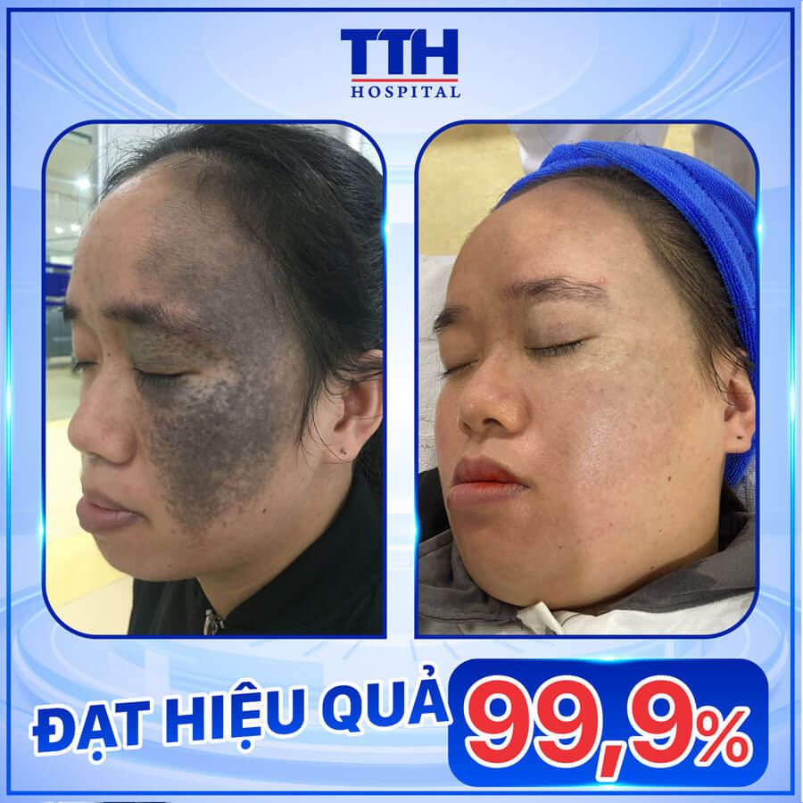 Xóa chàm bớt Hiệu quả đạt 99.9%