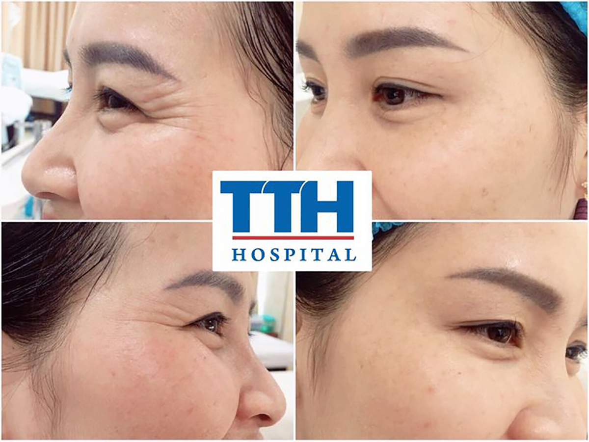 Giảm thiểu nếp nhăn và làm mờ các dấu hiệu lão hóa trên da