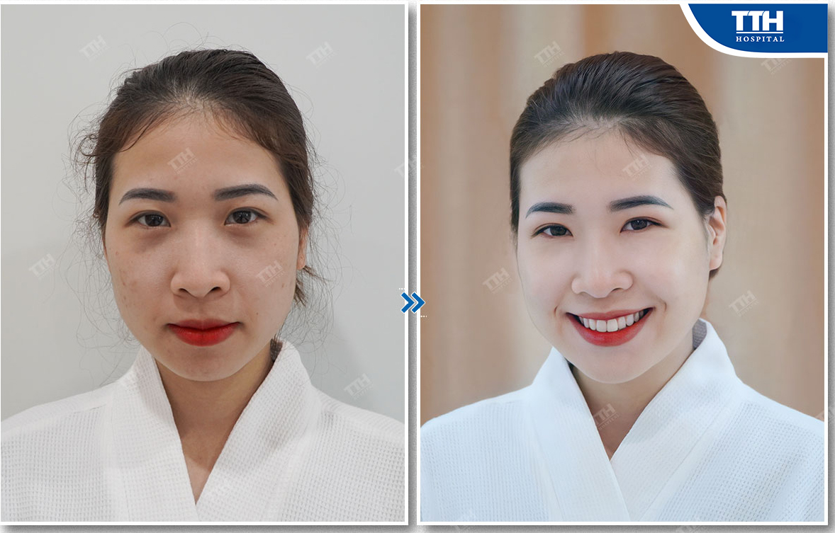 Khách hàng sau một liệu trình điều trị da nhăn ở bệnh viện Thái Thượng Hoàng