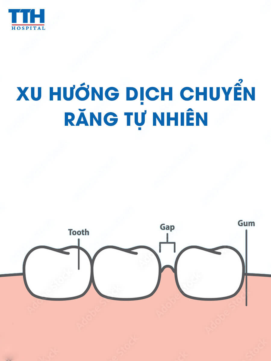 Xu hướng dịch chuyển răng tự nhiên