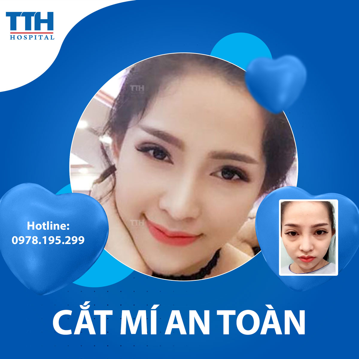 Cắt mí và những điều cần biết trước khi làm