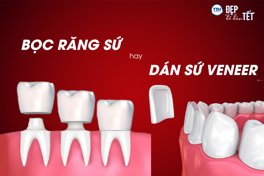 Nên bọc răng sứ hay dán sứ Veneer? Răng sứ thẩm mỹ uy tín tại Nghệ An
