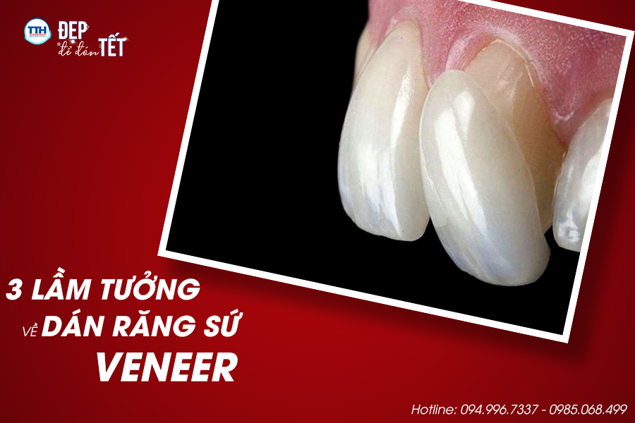 Top 3 lầm tưởng thường gặp về dán răng sứ Veneer