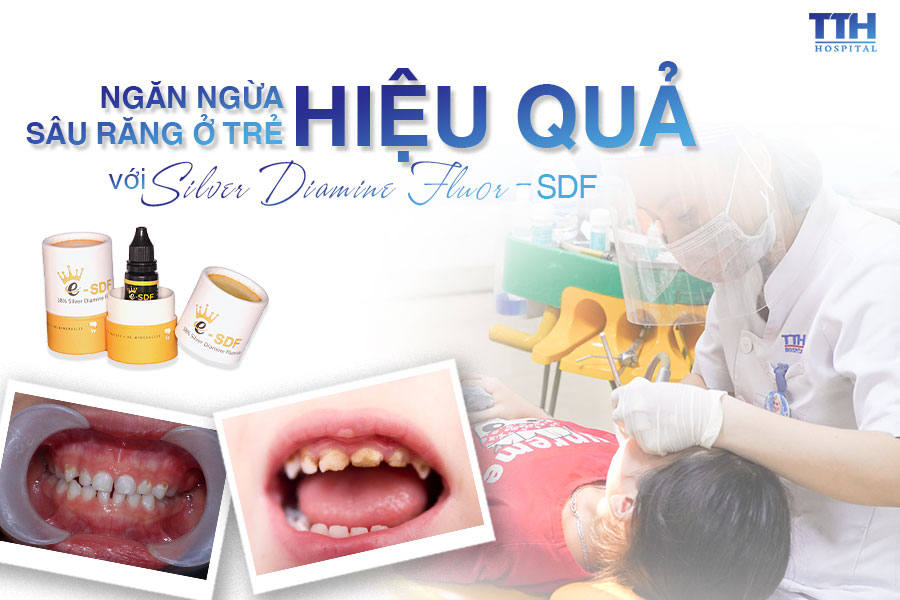 Ngăn ngừa sâu răng hiệu quả ở trẻ em bằng Silver Diamine Fluor - SDF