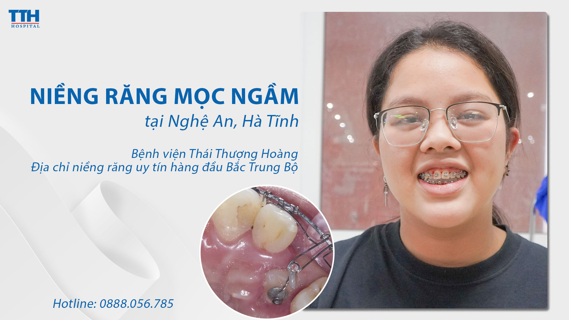 Niềng răng mọc ngầm tại Nghệ An, Hà Tĩnh