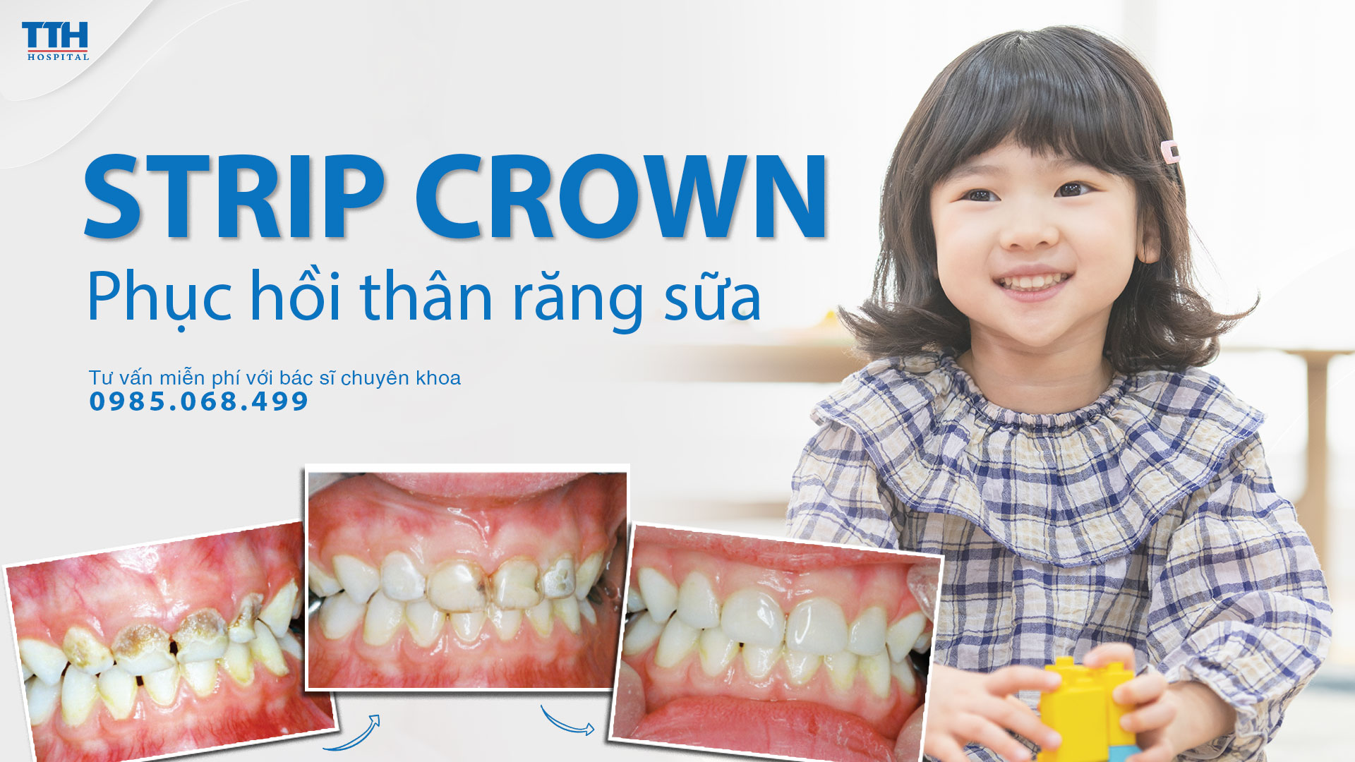 Phục hồi thân răng sữa bằng Strip crown. Thái Thượng Hoàng - Bệnh viện răng hàm mặt uy tín Nghệ An, Hà Tĩnh