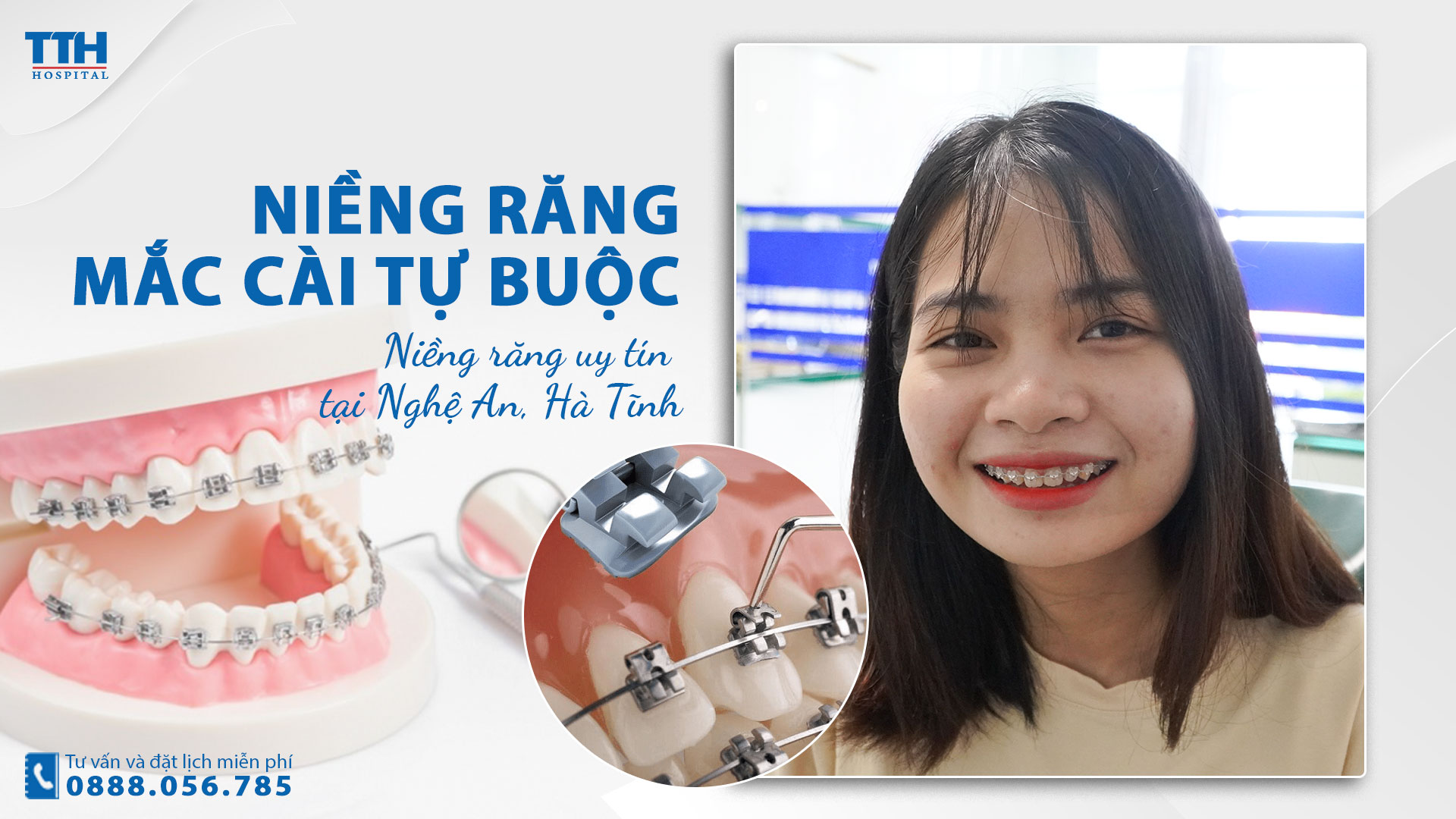 Niềng răng mắc cài tự buộc là gì? Niềng răng uy tín tại Nghệ An, Hà Tĩnh