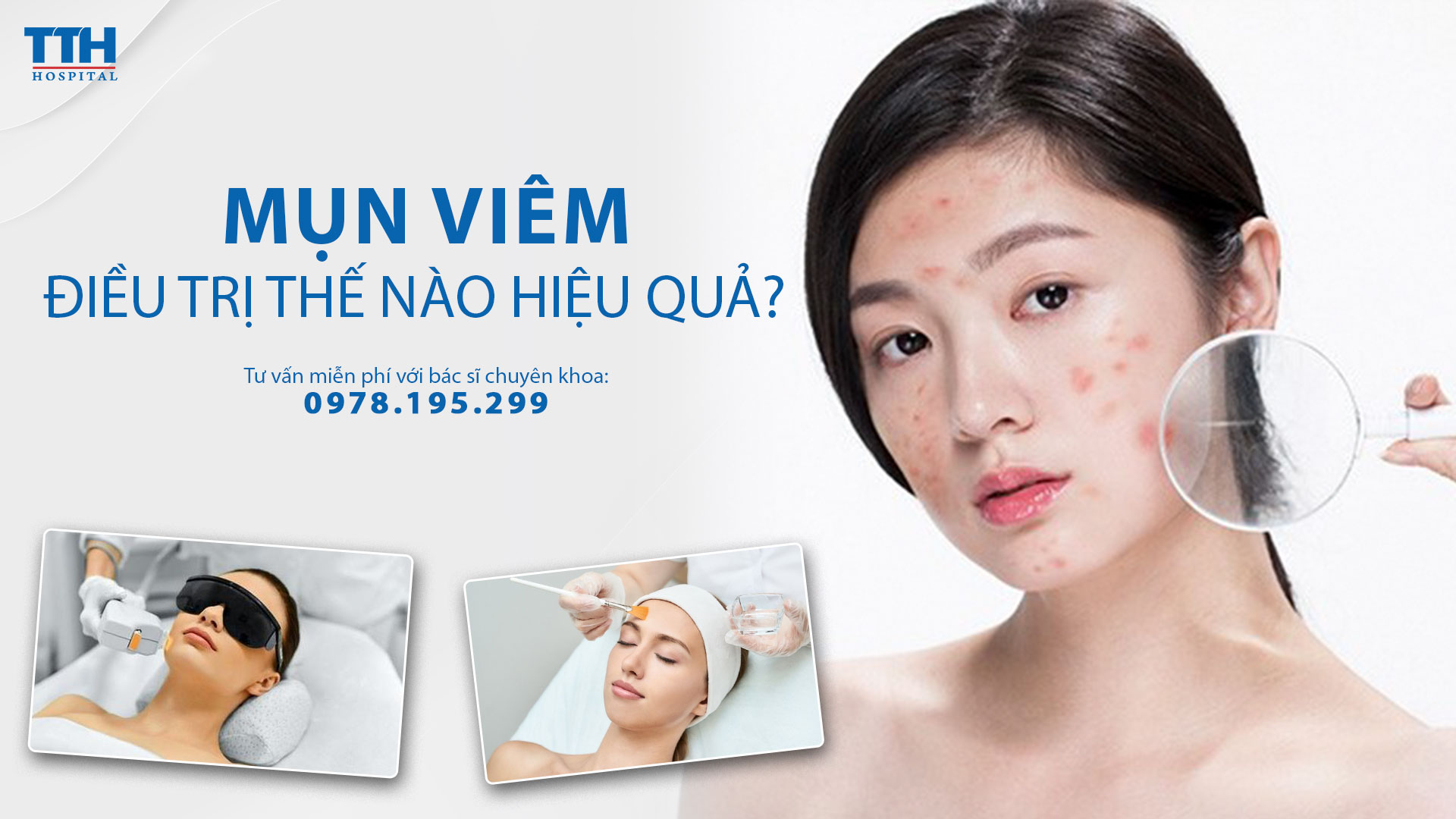 Mụn viêm: Điều trị thế nào hiệu quả?
