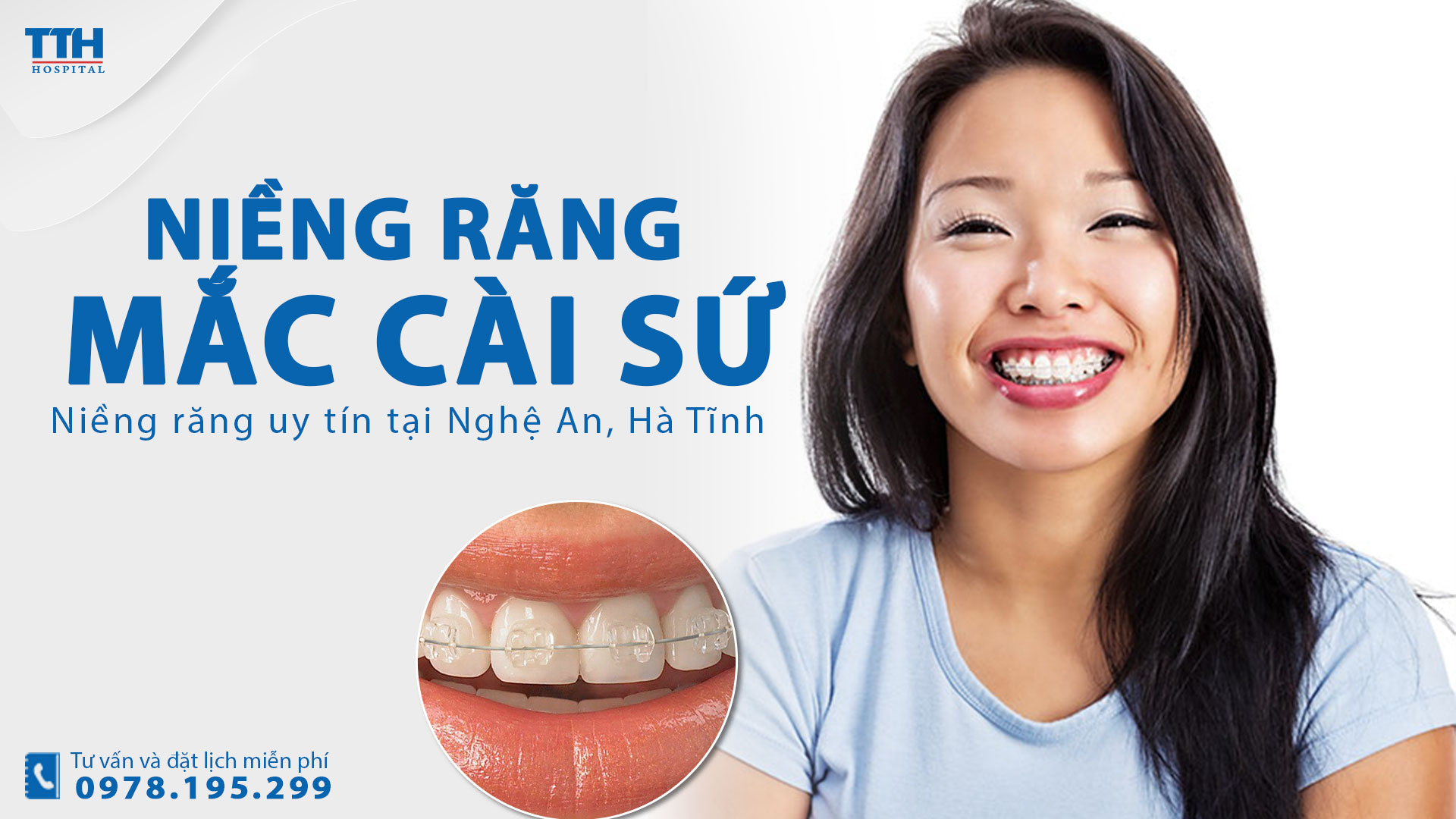 Niềng răng mắc cài sứ là gì? Niềng răng uy tín tại Nghệ An, Hà Tĩnh