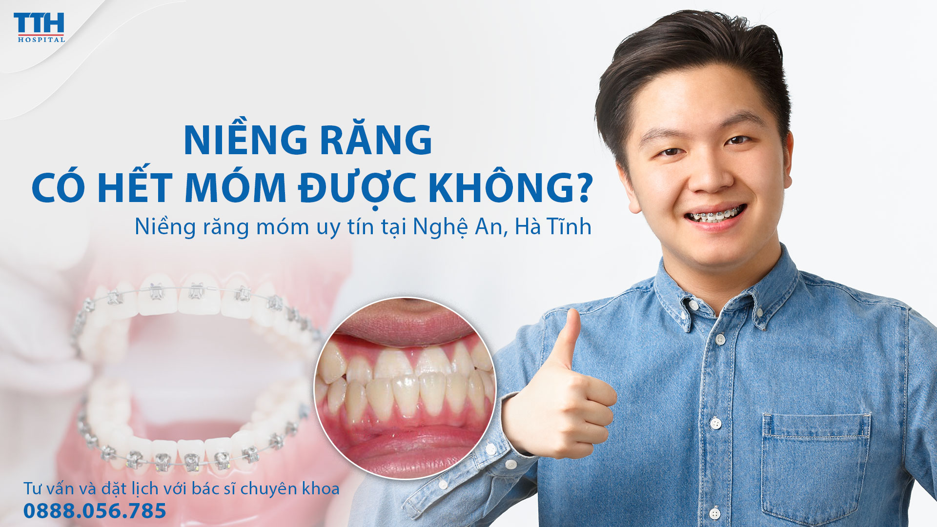 Niềng răng có hết móm được không? Bệnh viện Thái Thượng Hoàng - Địa chỉ niềng răng móm uy tín Nghệ An, Hà Tĩnh
