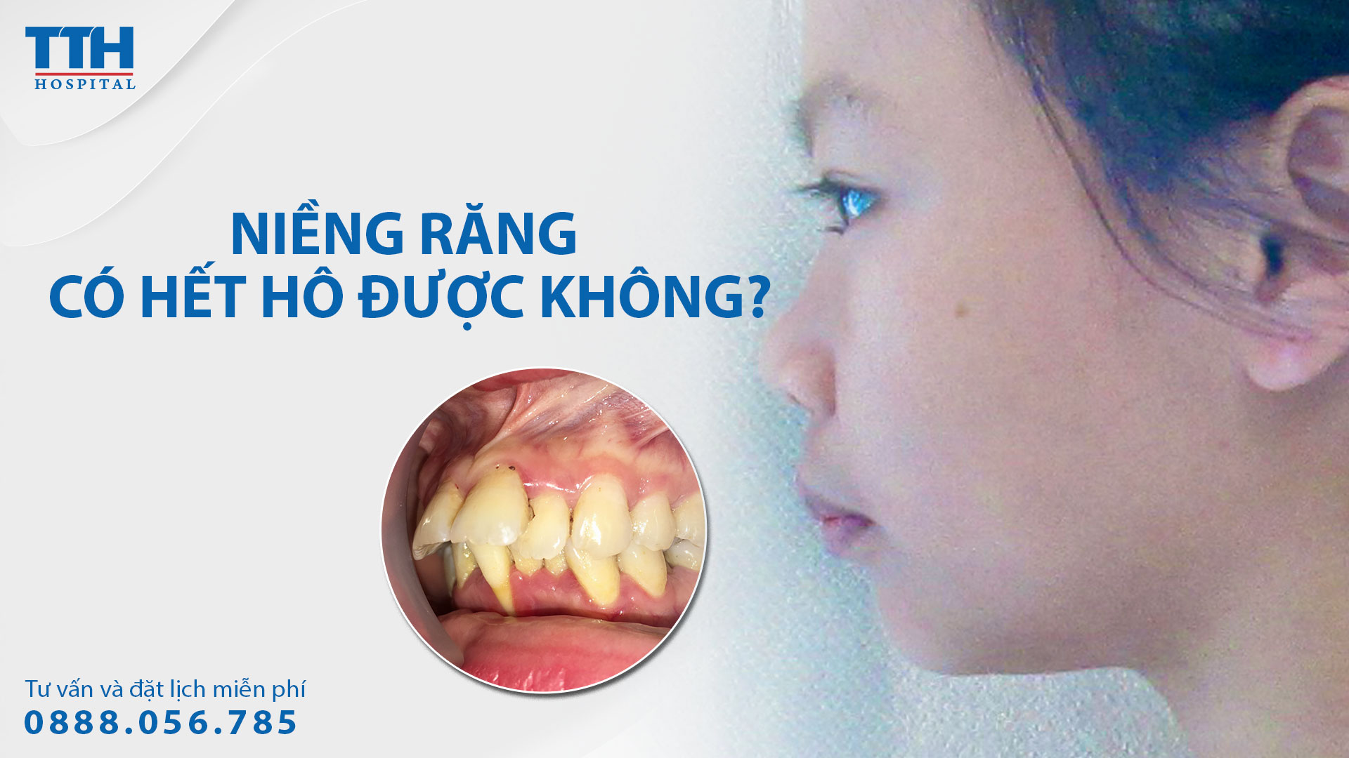 Niềng răng có hết hô không? Niềng răng uy tín hàng đầu Nghệ An, Hà Tĩnh tại Bệnh viện Thái Thượng Hoàng