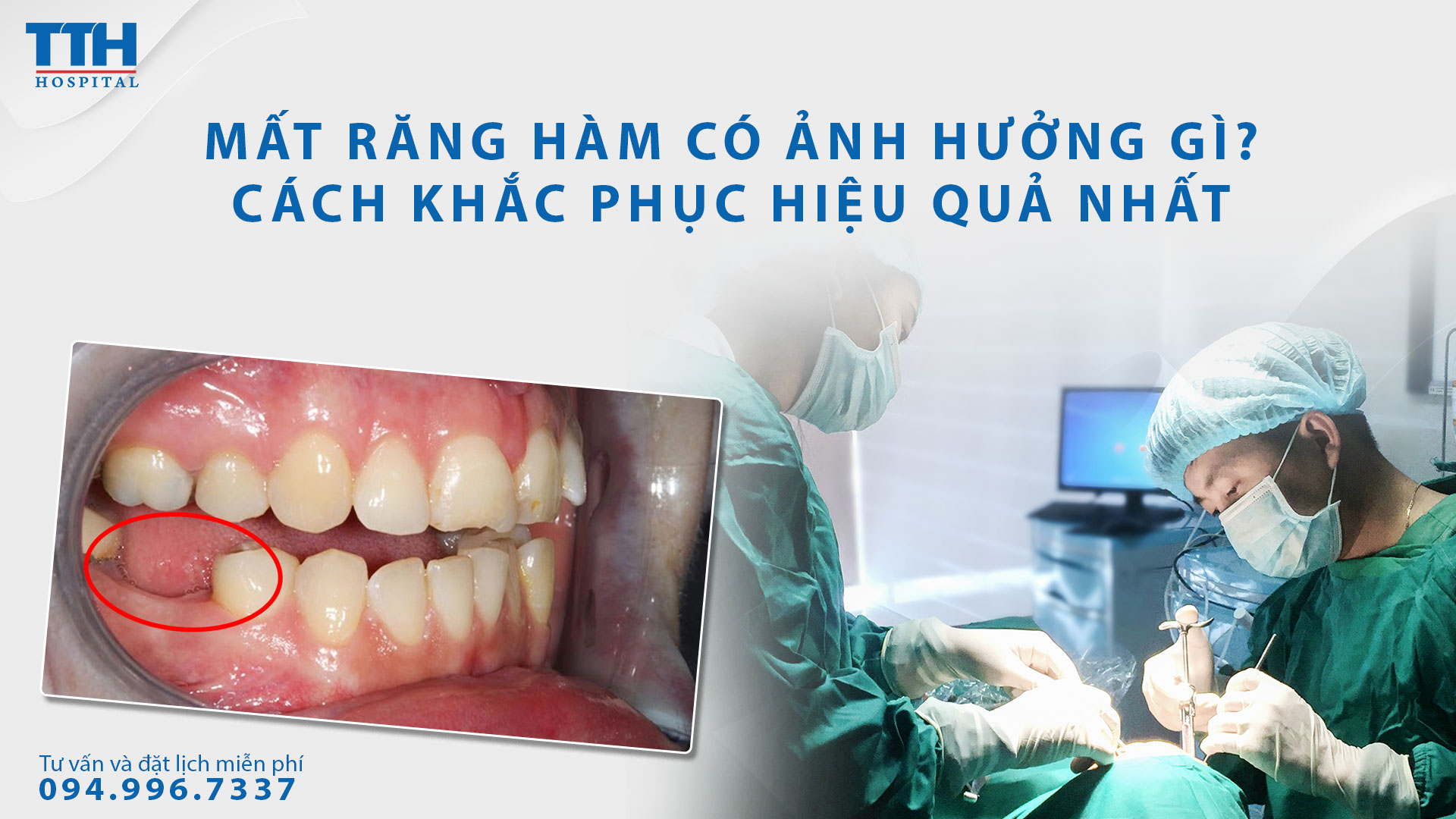Mất răng hàm có ảnh hưởng gì không? Cách khắc phục hiệu quả nhất.