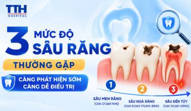 3 MỨC ĐỘ SÂU RĂNG THƯỜNG GẶP - CÀNG PHÁT HIỆN SỚM, CÀNG DỄ ĐIỀU TRỊ