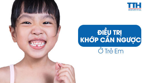 Điều Trị Khớp Cắn Ngược ở Trẻ Em