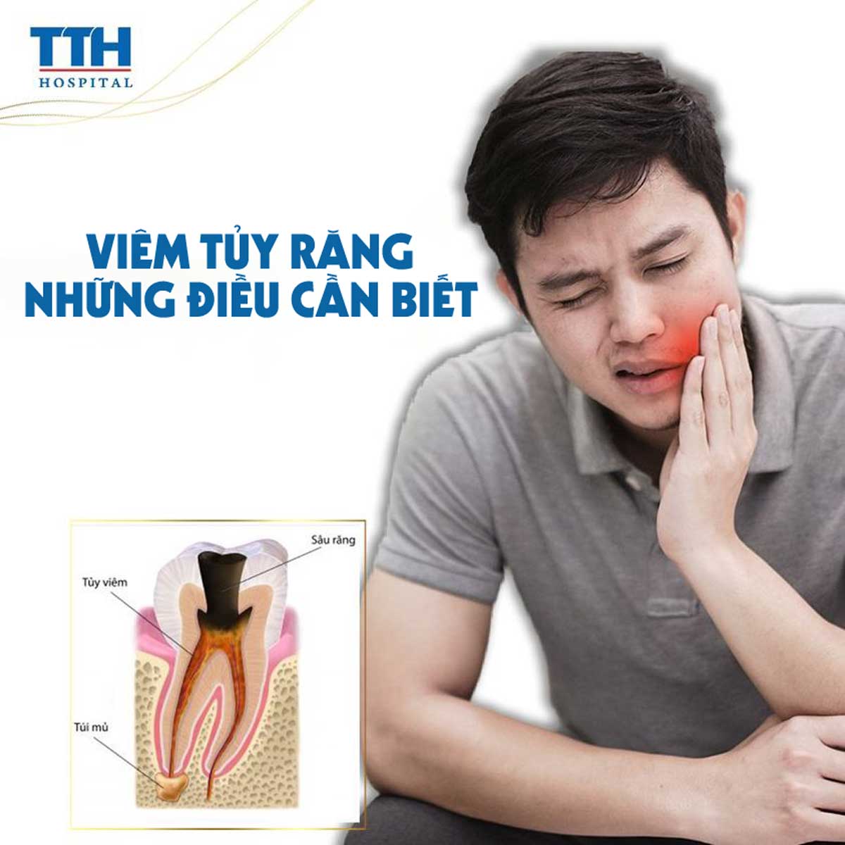 Viêm tủy răng và những điều cần biết